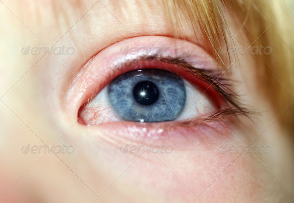 eye of child, close-up of blue iris with white of eyeball looking red and poorly