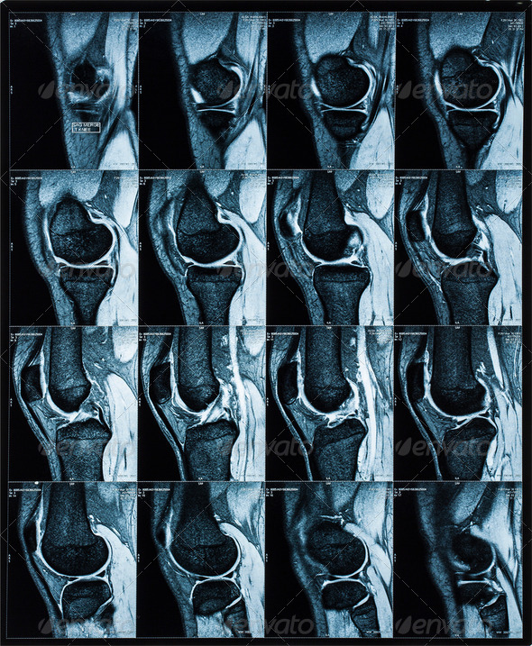 Magnetic resonance tomography (MRT) images of knee